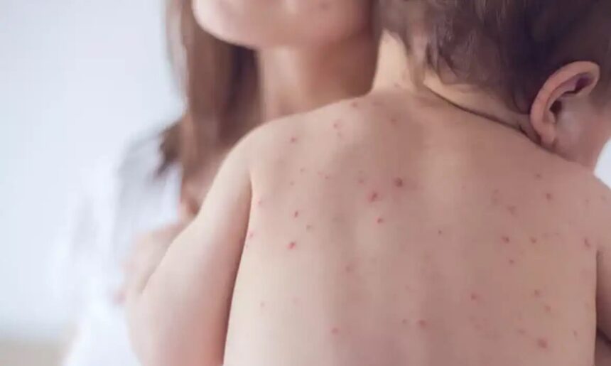 Estado de São Paulo reforça necessidade de vacinação contra o sarampo